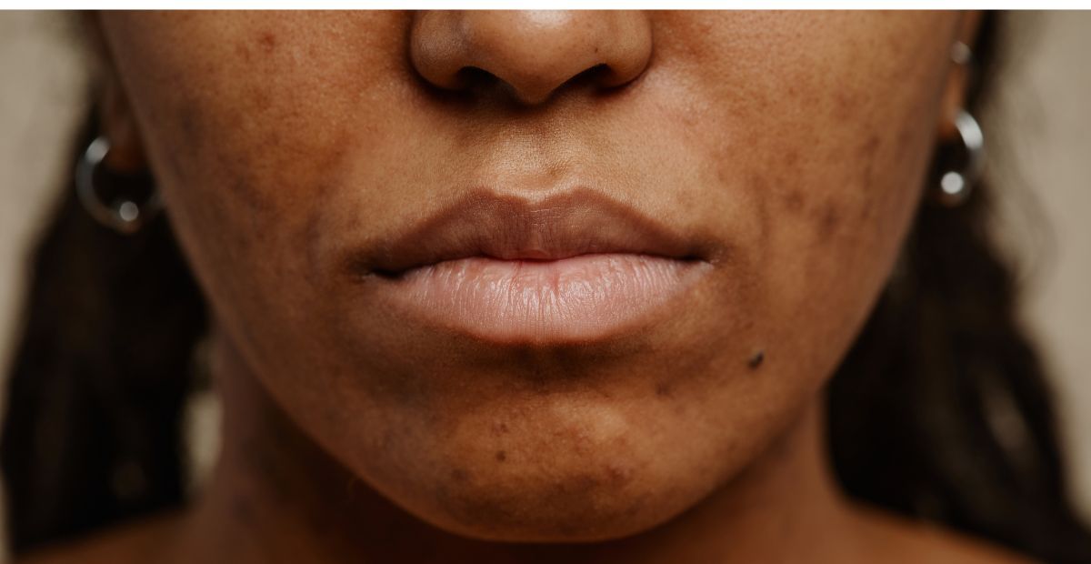 purge de la peau : comprendre ce phénomène pour mieux prendre soin de sa peau - Beauté Hérins